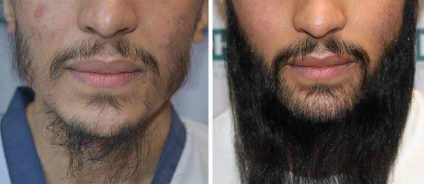  beard hair transplant results